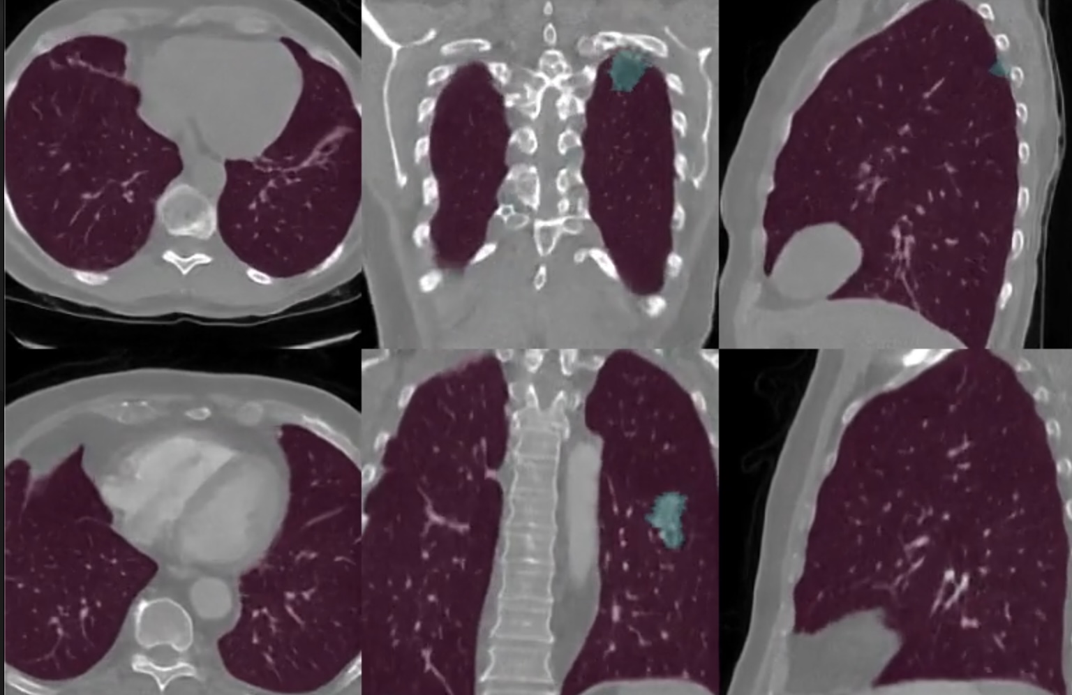 Synthesis of 3D CT scans and lung cancer nodules